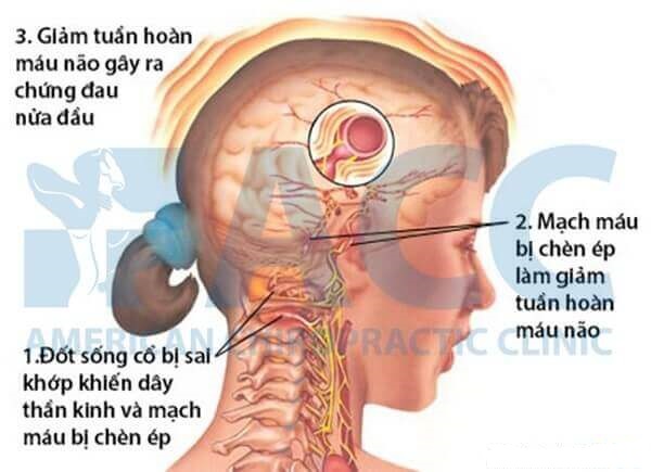 Chứng đau nửa đầu và cách xử trí