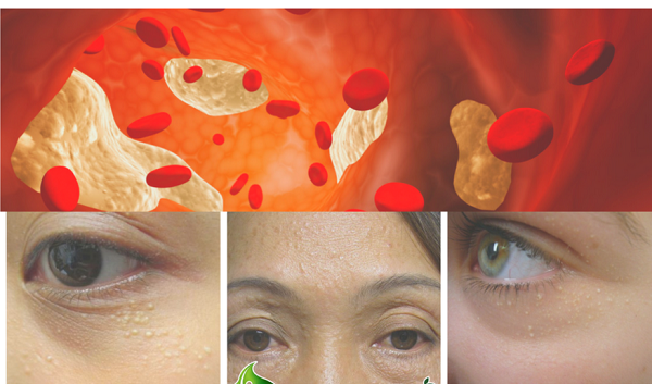 Xử lý và phòng ngừa cholesterol tích tụ quanh mắt