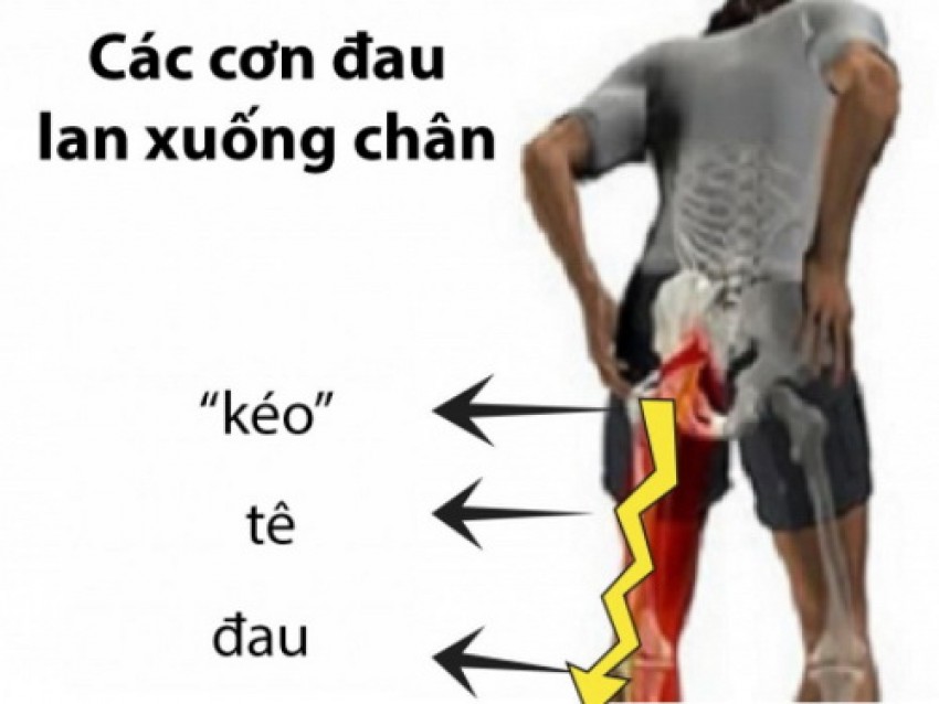 Cơn đau vùng thắt lưng.