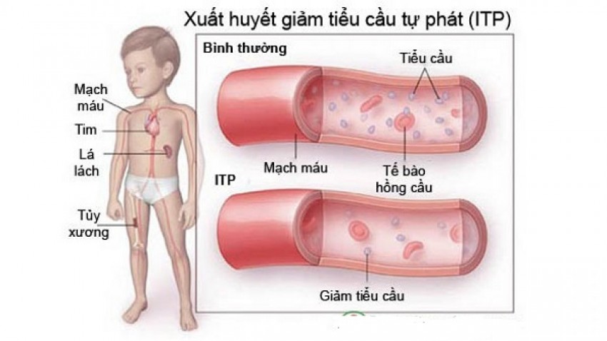 Hình ảnh người bệnh xuất huyết giảm tiểu cầu.
