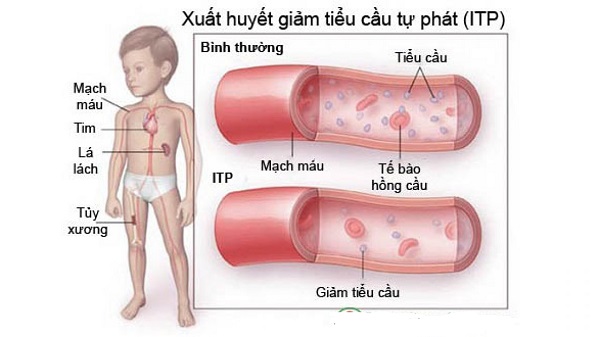 Cần làm gì khi bị xuất huyết giảm tiểu cầu?