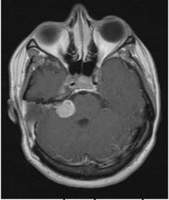 Khối u thần kinh tiền đình ở góc cầu - tiểu não gây điếc đột ngột.