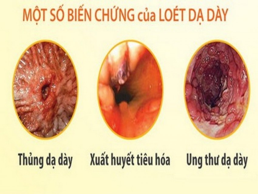 Loét dạ dày - tá tràng gây nhiều biến chứng nguy hiểm nếu không tuân thủ điều trị.