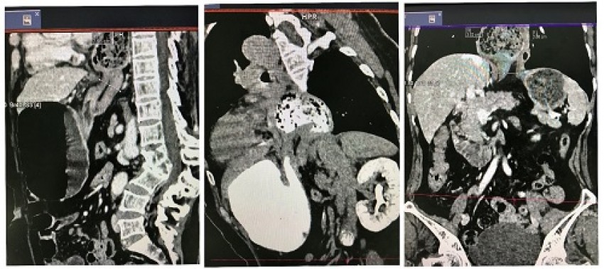 Hình ảnh thoát vị dạ dày thể hỗn hợp lên lồng ngực qua khe thực quản.