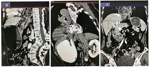 Cảnh giác với thoát vị hoành