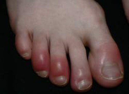 Những bài thuốc dân gian trị cước chân