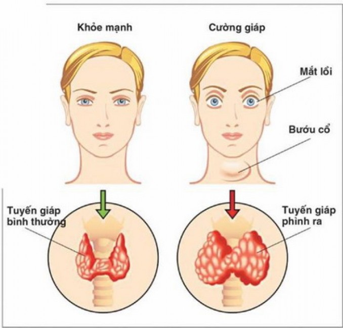 Bệnh cường giáp gây nhiều biến chứng nguy hiểm.
