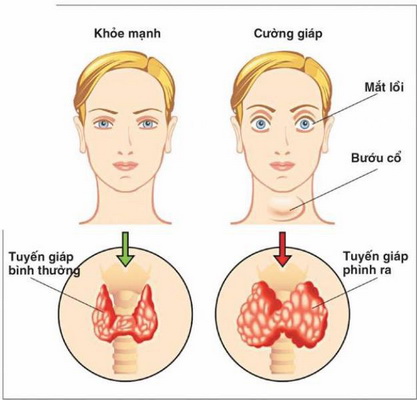 Biến chứng nguy hiểm do cường giáp