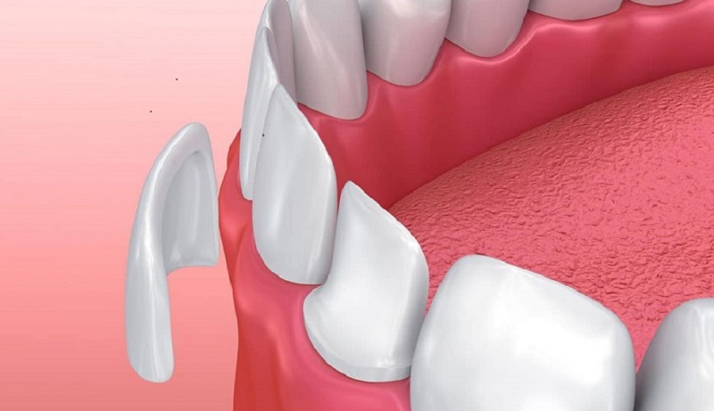Những trường hợp nên dán sứ veneer