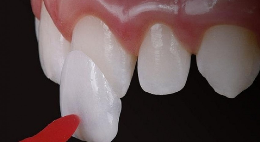 dán sứ veneer có bên không
