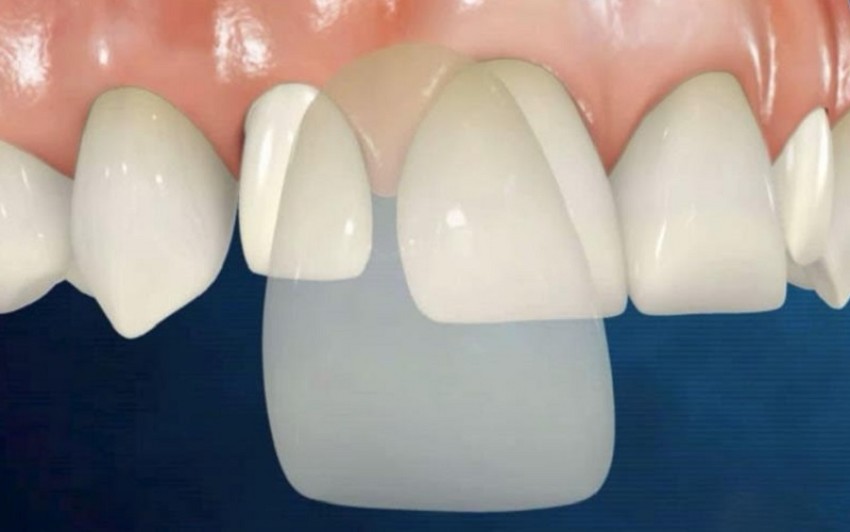 dán veneer giữ được bao lâu