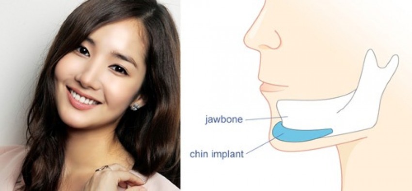 Cằm Lẹm Là Cằm Thế Nào? Có Khắc Phục Được Không?