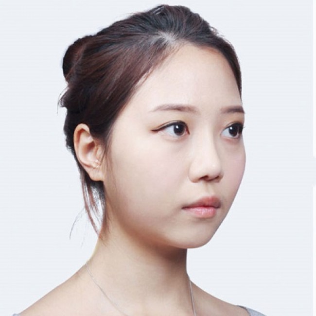 Cằm Lẹm Là Cằm Thế Nào? Có Khắc Phục Được Không?