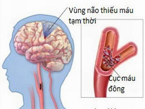 Nhận biết và phòng ngừa thiểu năng tuần hoàn não