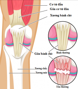 Đứt gân bánh chè – Đừng để điều trị chậm trễ !