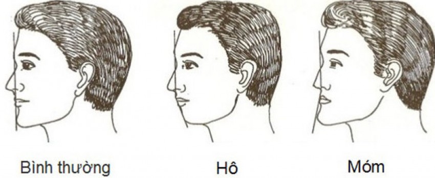 hàm hô