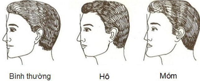 Phẫu thuật hàm hô như thế nào? Chi phí và phương pháp thực hiện