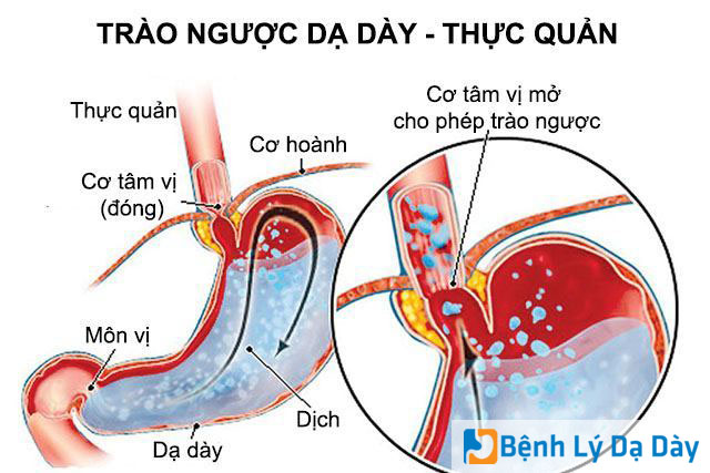 Ðiều trị hiệu quả chứng co thắt thực quản