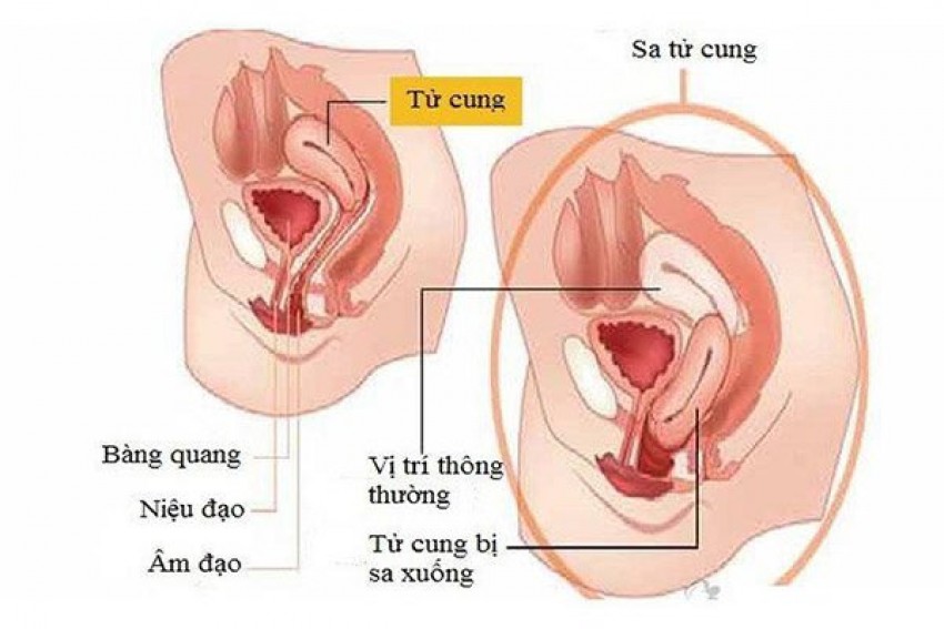 Hình ảnh sa tử cung.