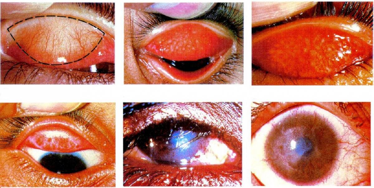 Phòng ngừa đau mắt mùa bão lũ