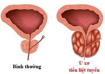 Giải pháp giúp u xơ tuyến tiền liệt không còn đáng sợ