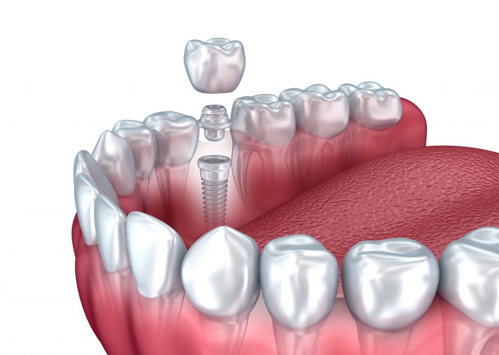 TRỒNG RĂNG IMPLANT NHƯ THẾ NÀO?
