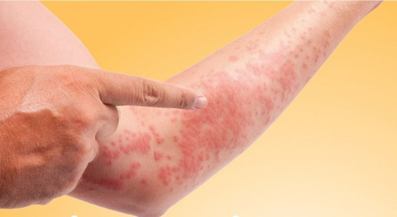 Mụn nhọt, mẩn ngứa ngày hè không chỉ do thời tiết nóng