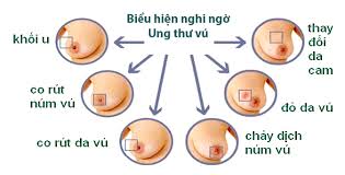 Mách bạn tránh yếu tố nguy cơ dẫn đến ung thư vú