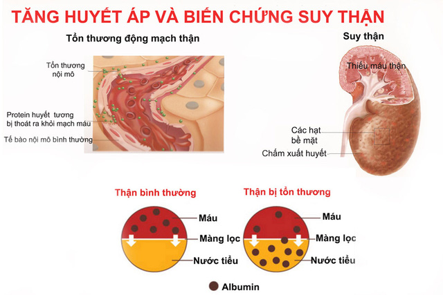 Dự phòng tăng huyết áp ở phụ nữ luống tuổi