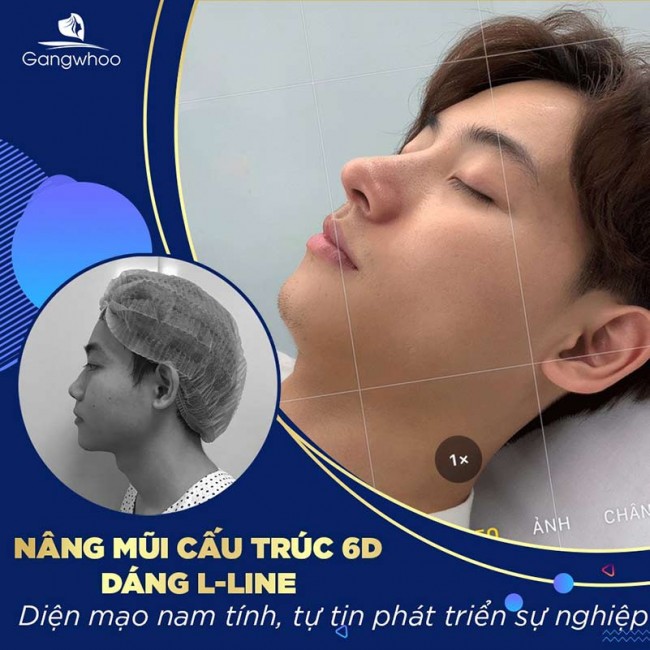 Nâng mũi bao lâu thì hết sưng?