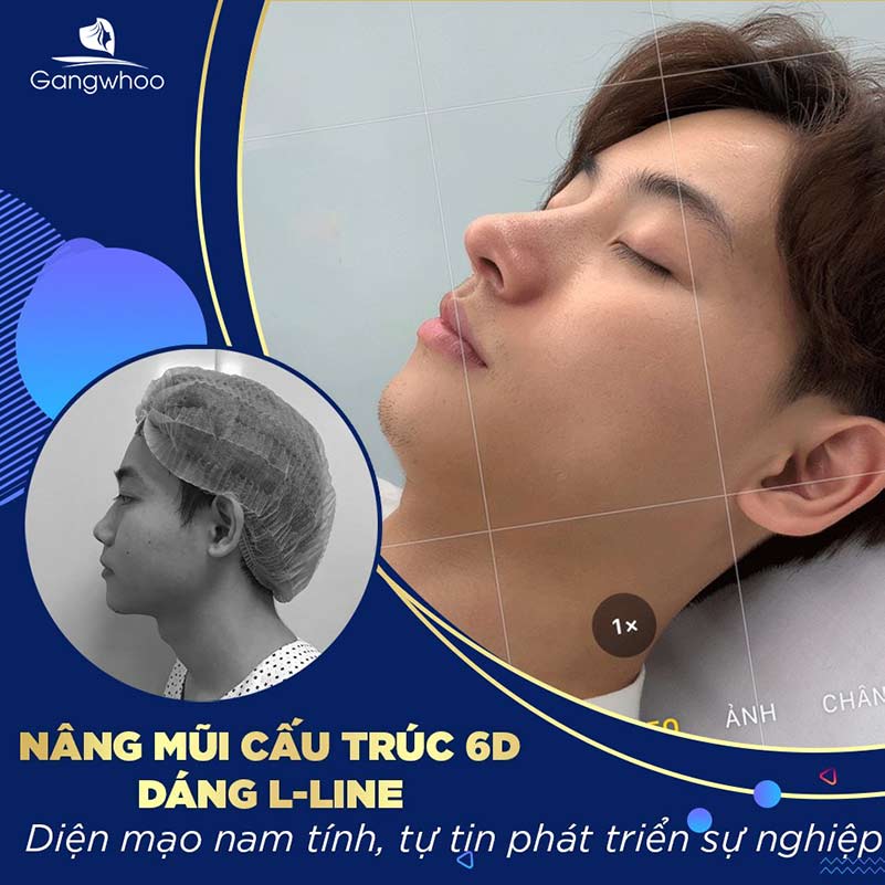 Nâng mũi bao lâu thì hết sưng?