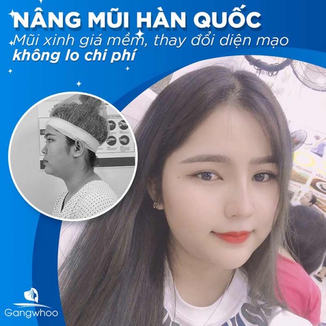 Nâng Mũi Hàn Quốc Có Tốt Không?