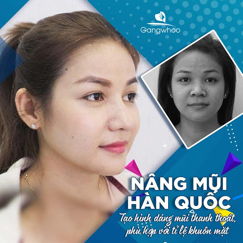 Nâng Mũi Hàn Quốc Có Tốt Không?