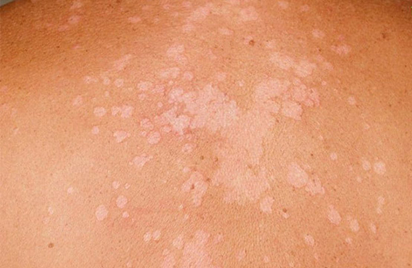 Không nên  tự điều trị bệnh nấm da  do… “giống nhau”