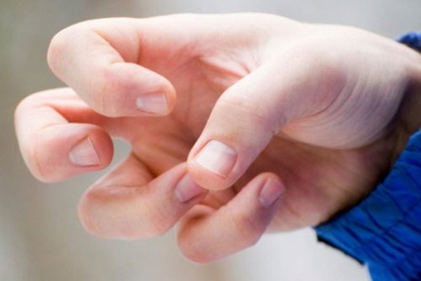 Kiểm soát cơn động kinh