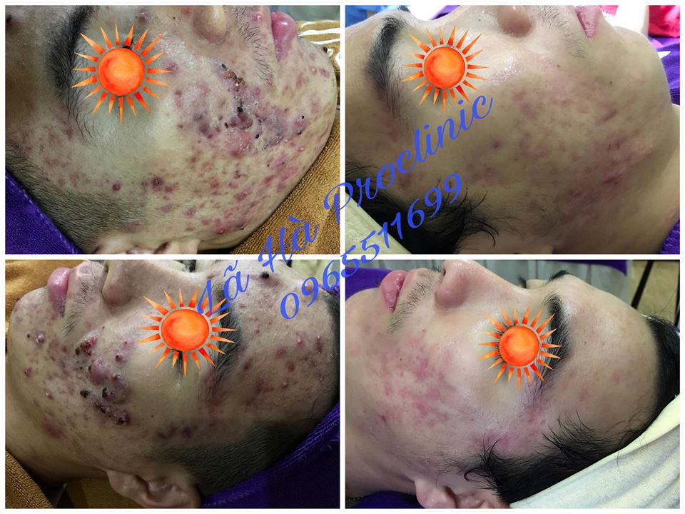 Điều trị mụn, giảm tối đa sẹo trên da