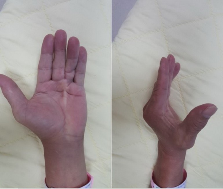 Nếu đau co rút bàn tay kéo dài, nên đi khám để tìm nguyên nhân.