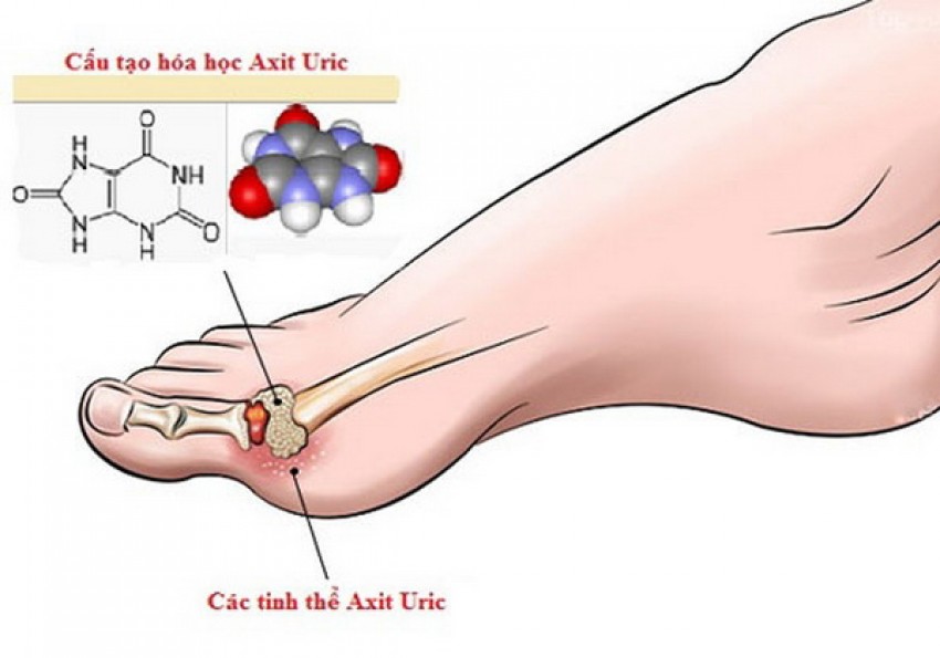 Các tinh thể acid uric lắng đọng tại khớp.
