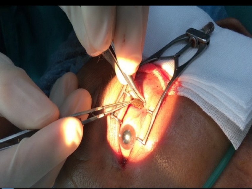 Ca gắp dị vật trong mắt.