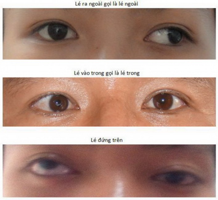 Cá hình thái lác (lé) mắt.