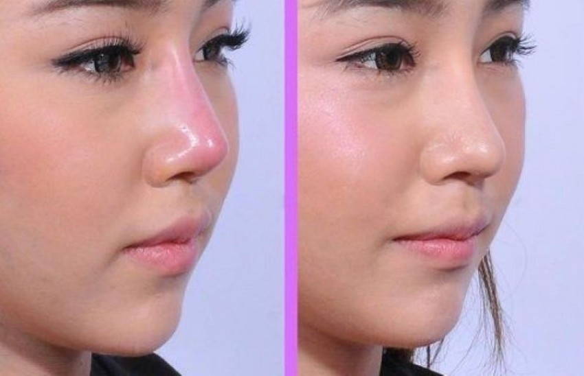 lộ sóng mũi