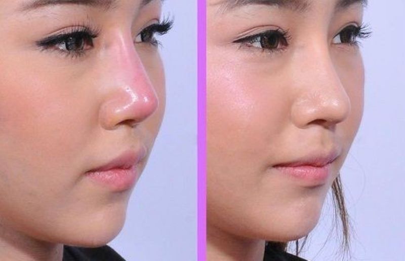 Nâng mũi bị lộ sóng, tuột sụn phải làm sao? Sửa ở đâu uy tín?