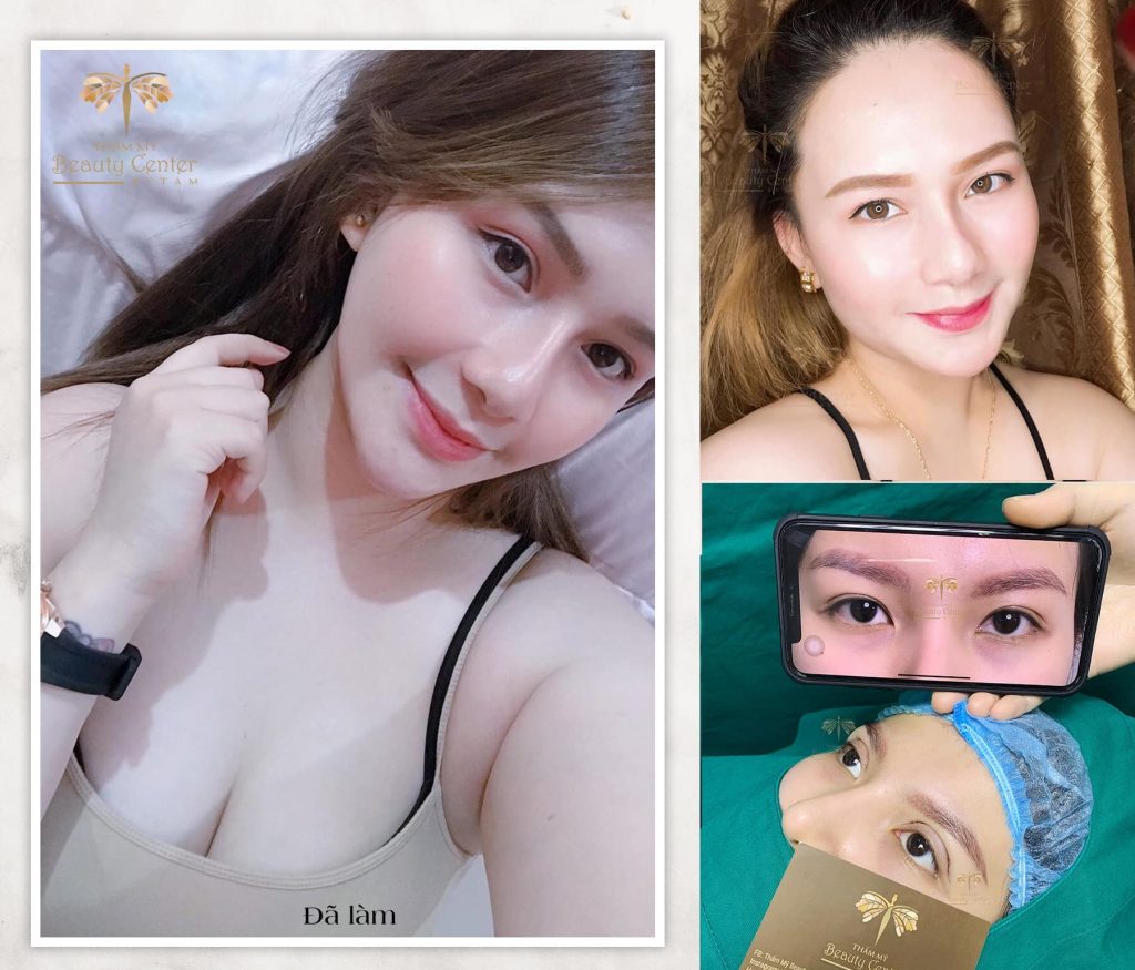 5 điều cần biết nếu muốn mở góc mắt trong, ngoài không để lại Sẹo