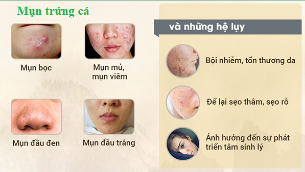 Cách hay để mụn trứng cá “lặn tăm”