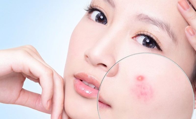 5 phương pháp hiệu quả nhất để xử lý các vấn đề sau mụn