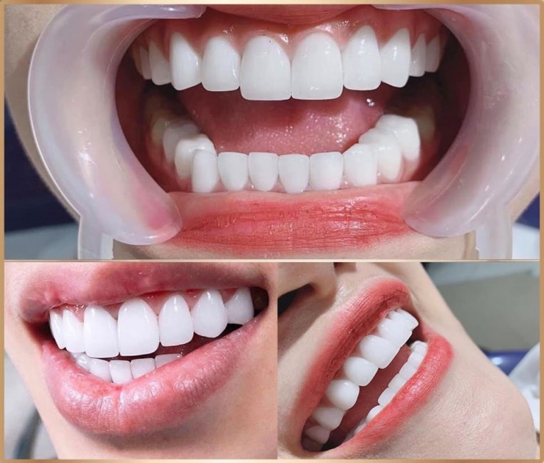 dán sứ veneer ceramill