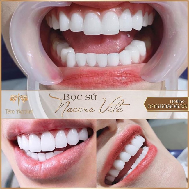 Dán sứ Nacera Vita