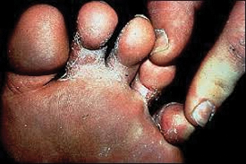 Nấm kẽ chân mùa mưa