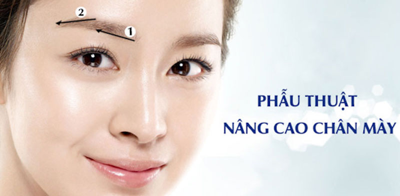 Nâng cung mày là gì? Chi phí và thời gian duy trì bao nhiêu lâu?