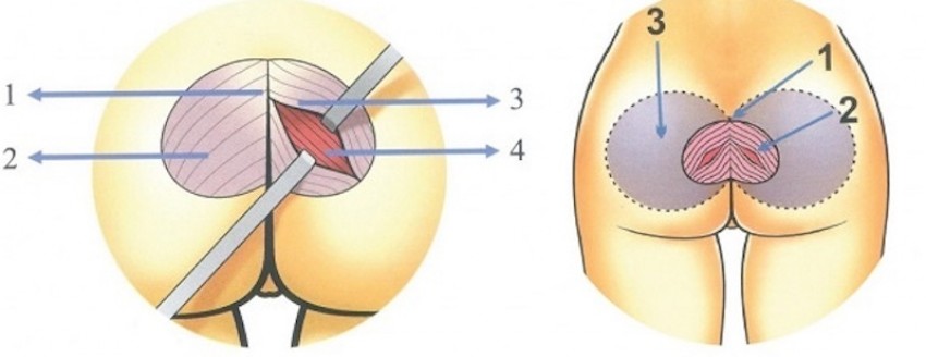 nâng mông nội soi